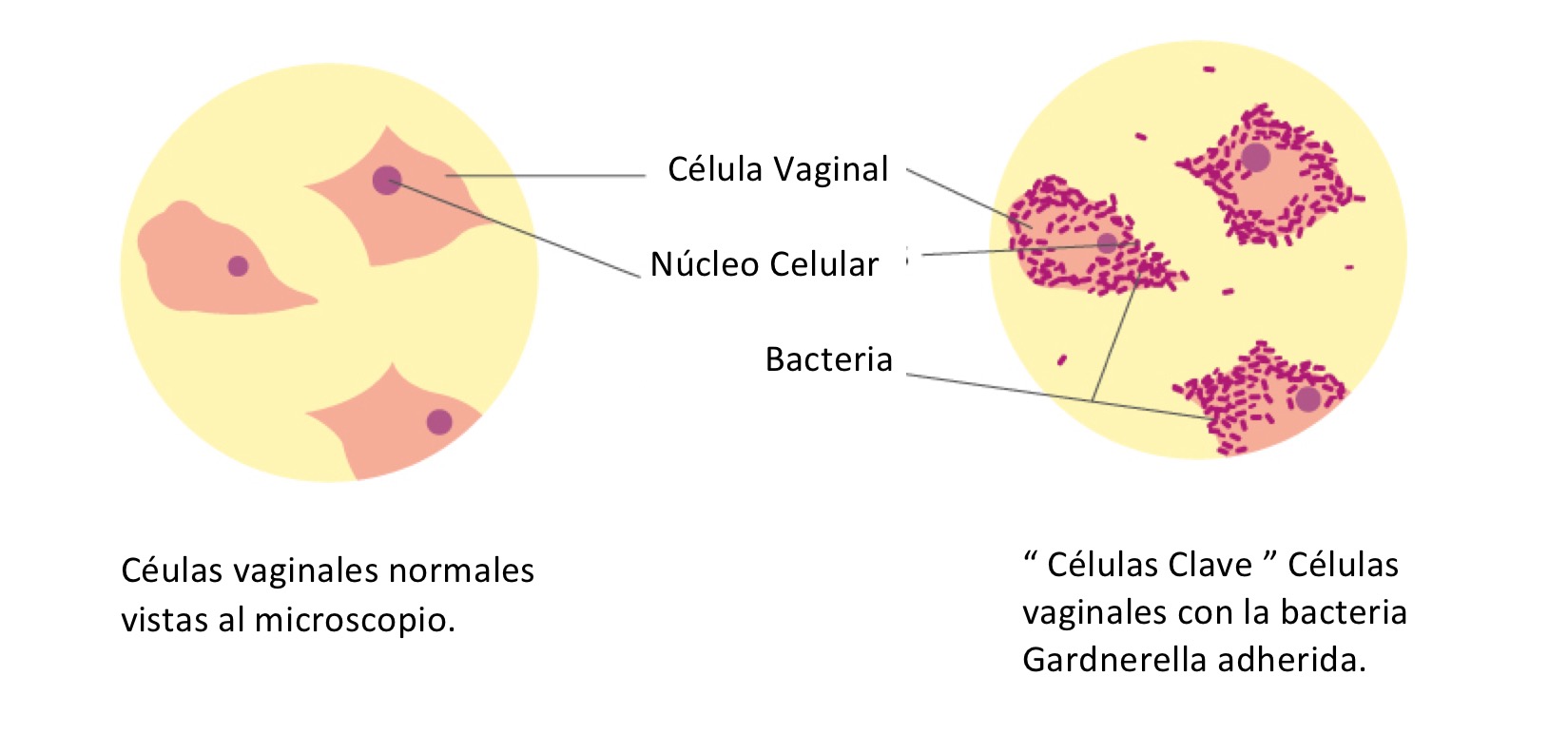 Células vaginales con la bacteria Gardnerella adherida